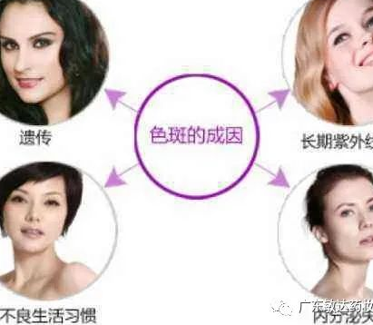 我们脸上为什么会长斑呢？激光祛斑到底靠不靠谱？
